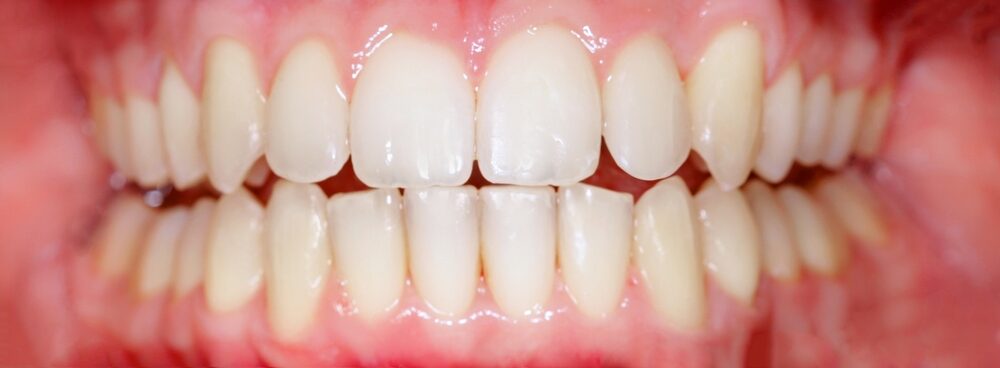 After treatment: straight, even teeth