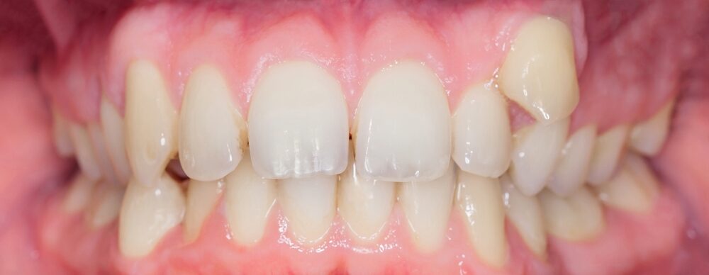 Before treatment: crooked, uneven teeth