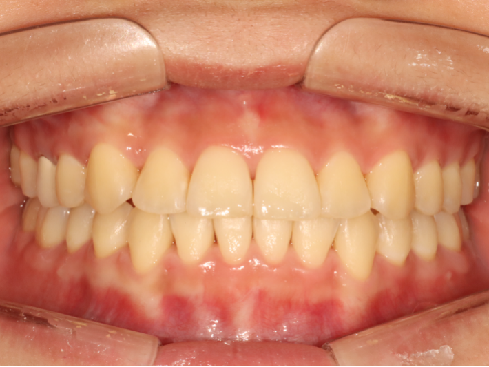 After Invisalign: straight, even teeth