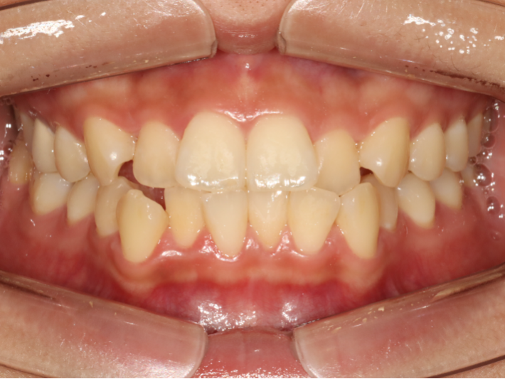 Before Invisalign: crooked, crowded teeth