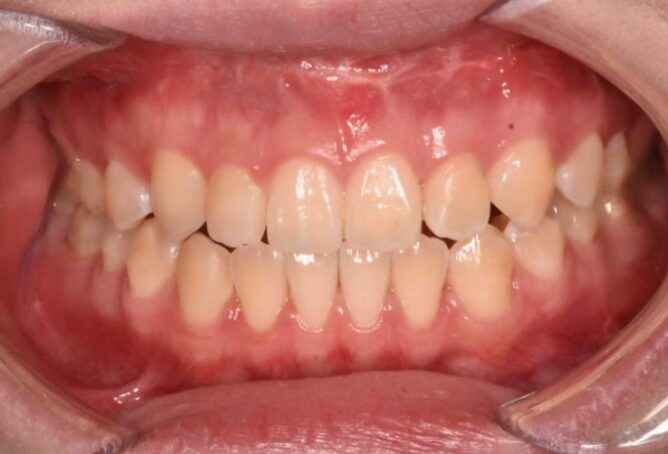 Underbite (Class III) case after Invisalign treatment