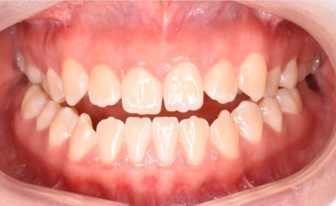 Underbite (Class III) before Invisalign treatment
