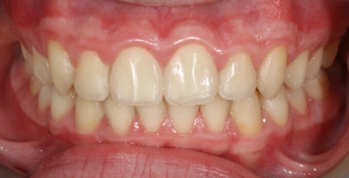 Crowding case after Invisalign treatment