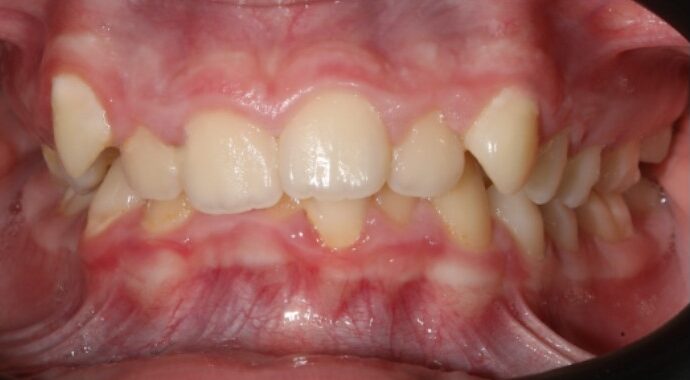 Crowded teeth before Invisalign treatment