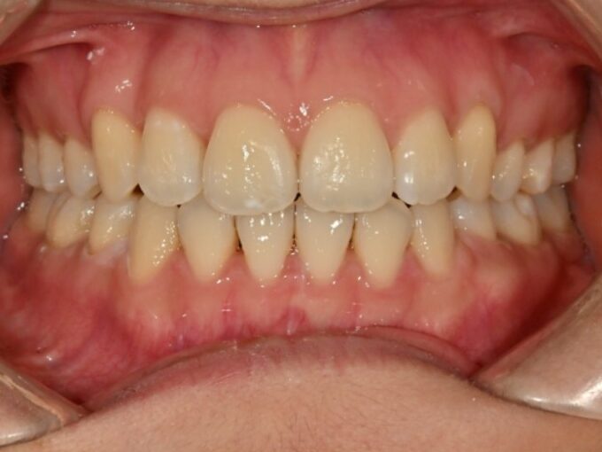 Crowding and open bite case after Invisalign treatment