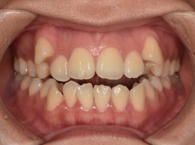 Crowding and open bite before Invisalign treatment