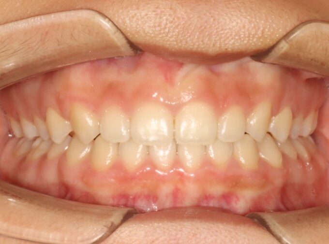 Deep bite case after Invisalign treatment