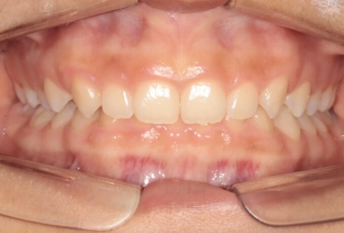 Deep bite before Invisalign treatment